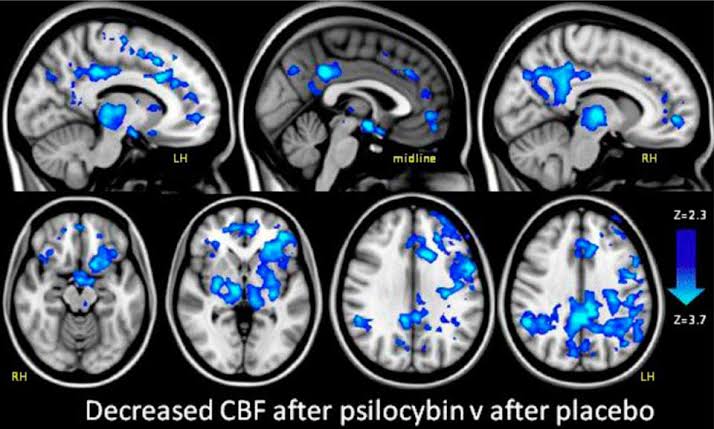 Read more about the article Brain Imaging in Modern Psychedelic Research